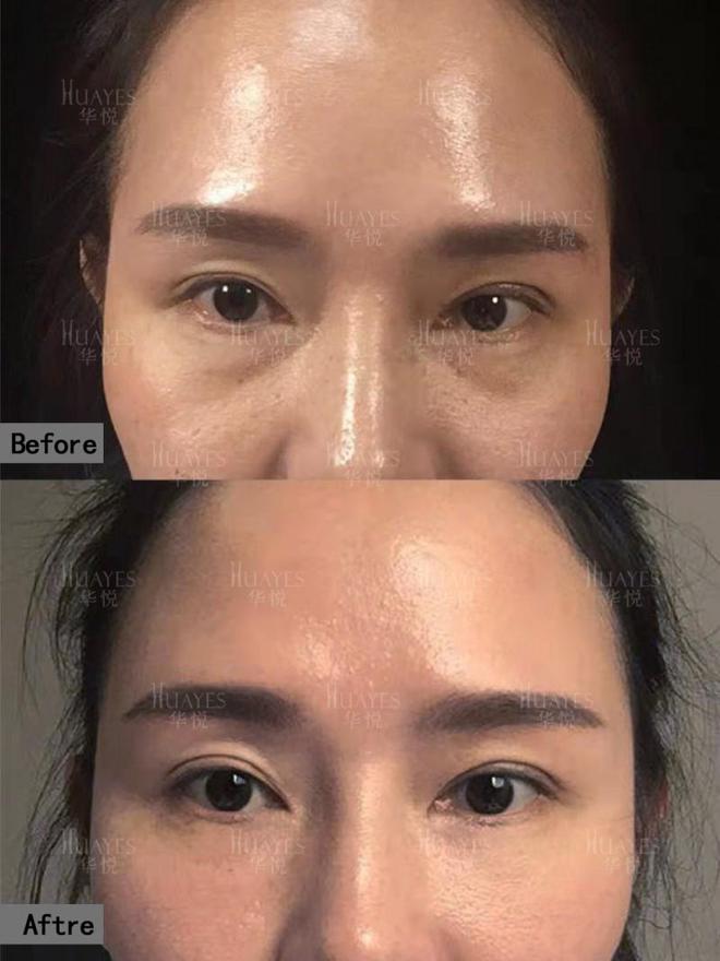 ：重塑眼部青春光彩一键重启眼部青春魅力爱游戏app网站手机版华悦白孝梅院长(图3)